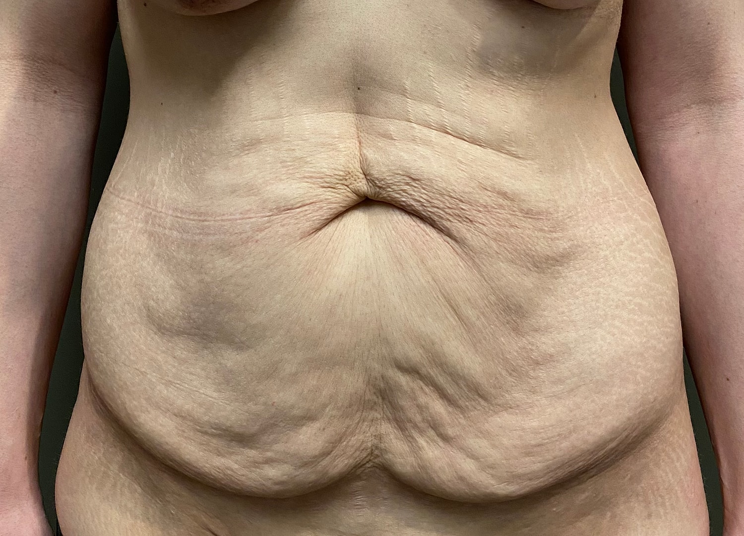 Abdominoplasty Before & After