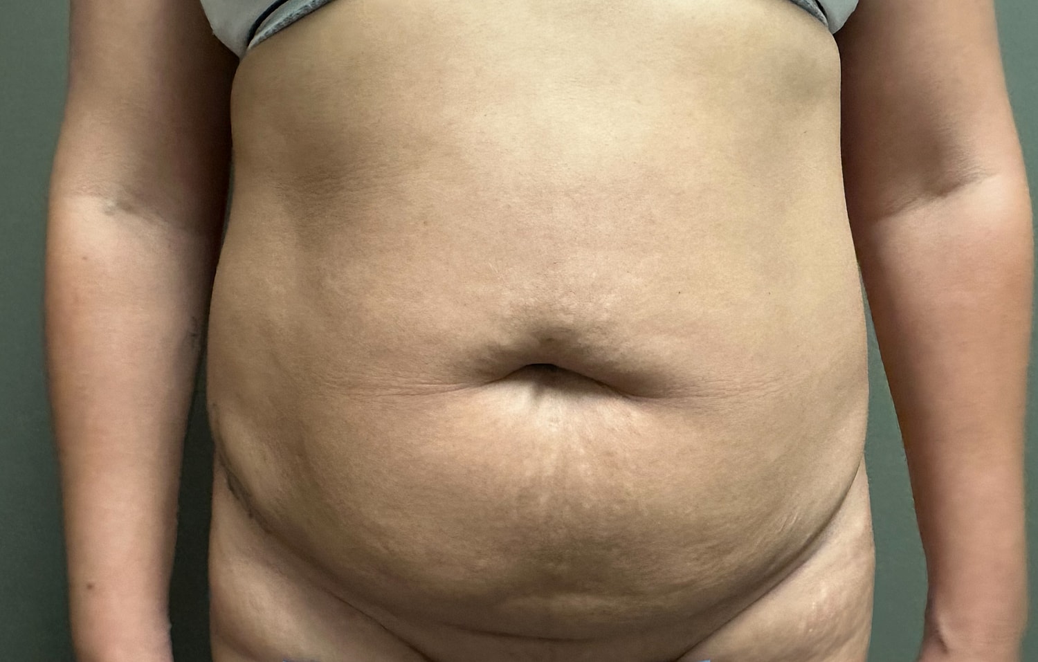 Abdominoplasty Before & After