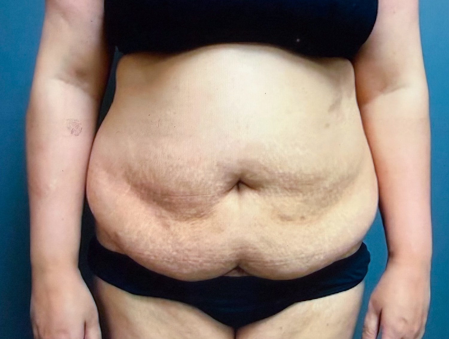 Abdominoplasty Before & After