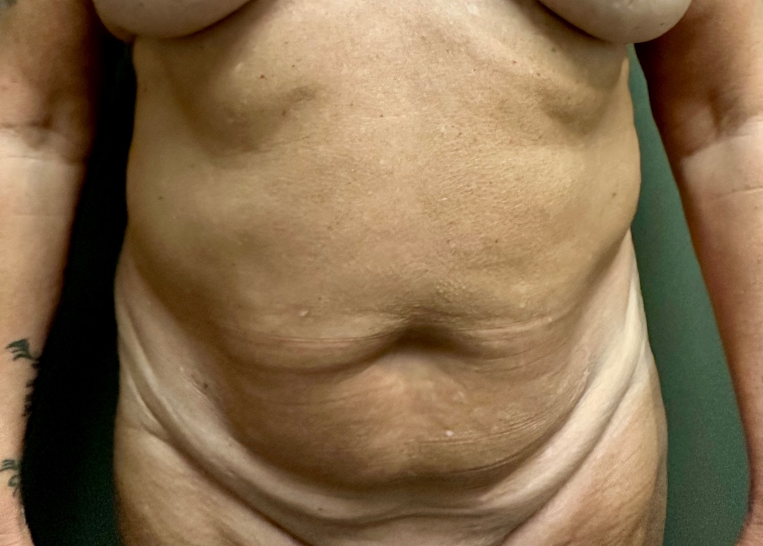 Abdominoplasty Before & After