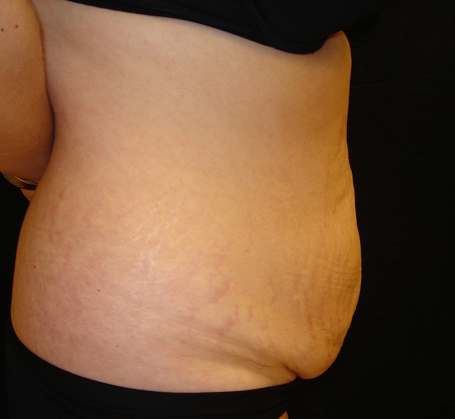 Abdominoplasty Before & After