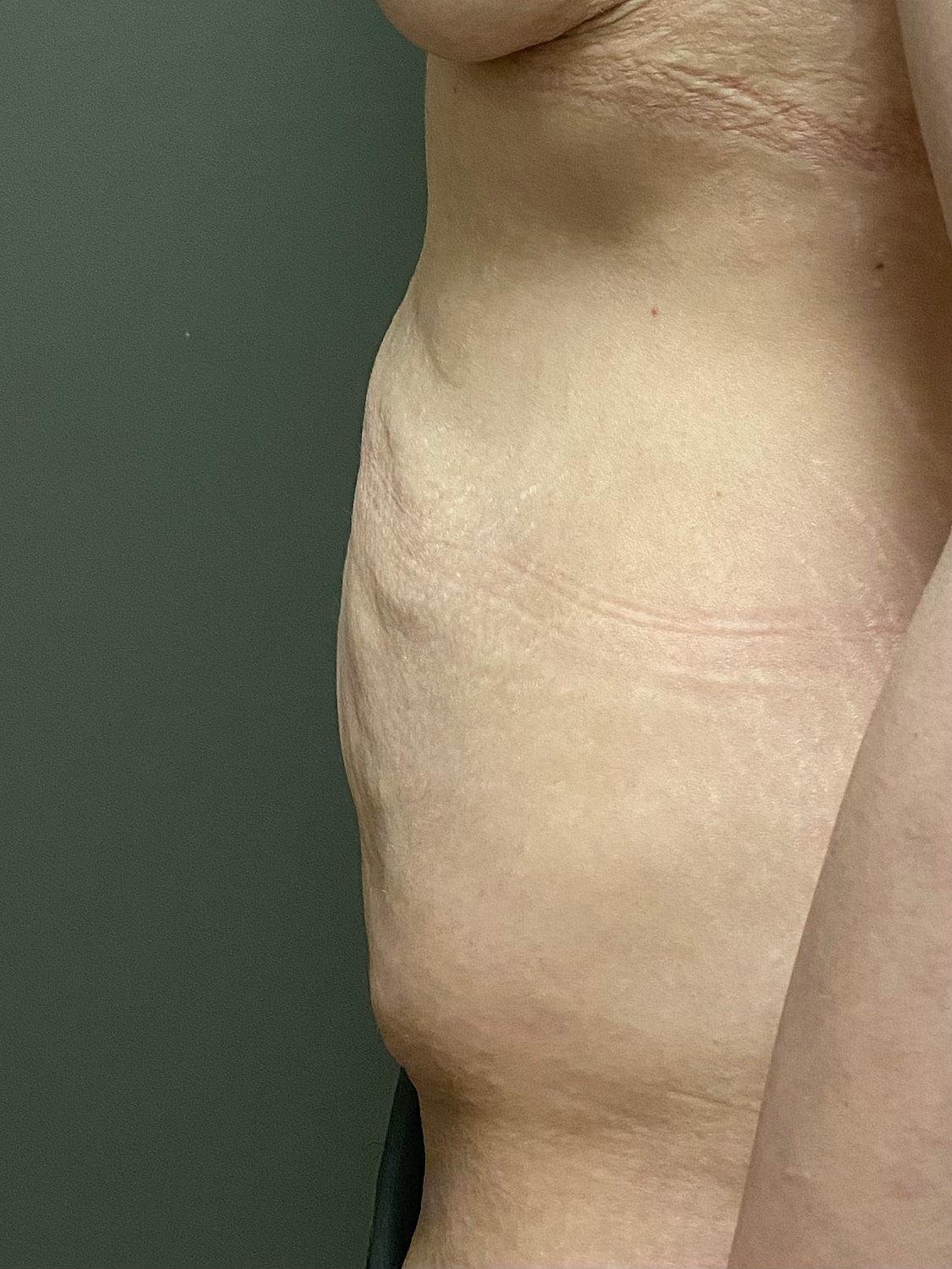 Abdominoplasty Before & After
