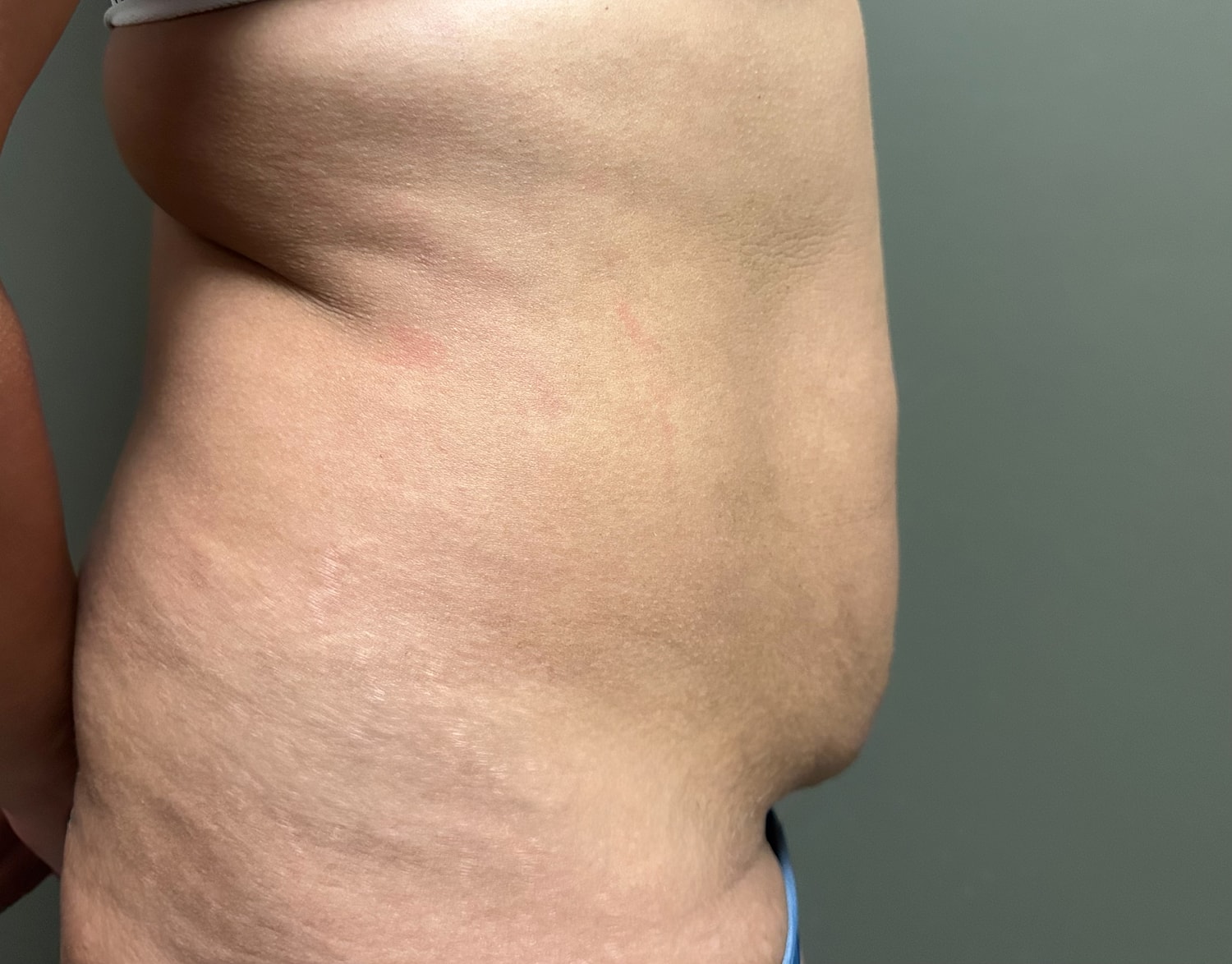 Abdominoplasty Before & After