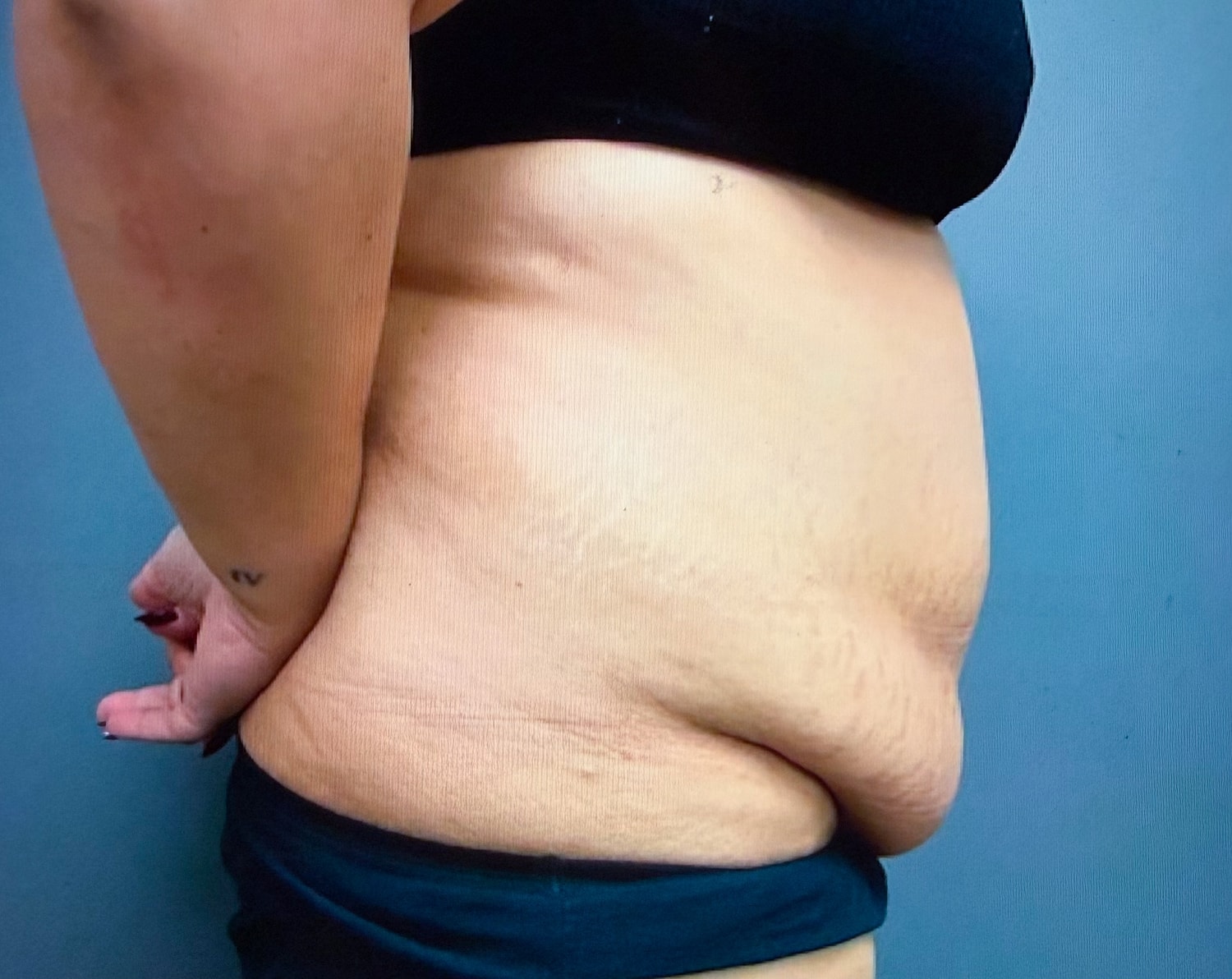 Abdominoplasty Before & After