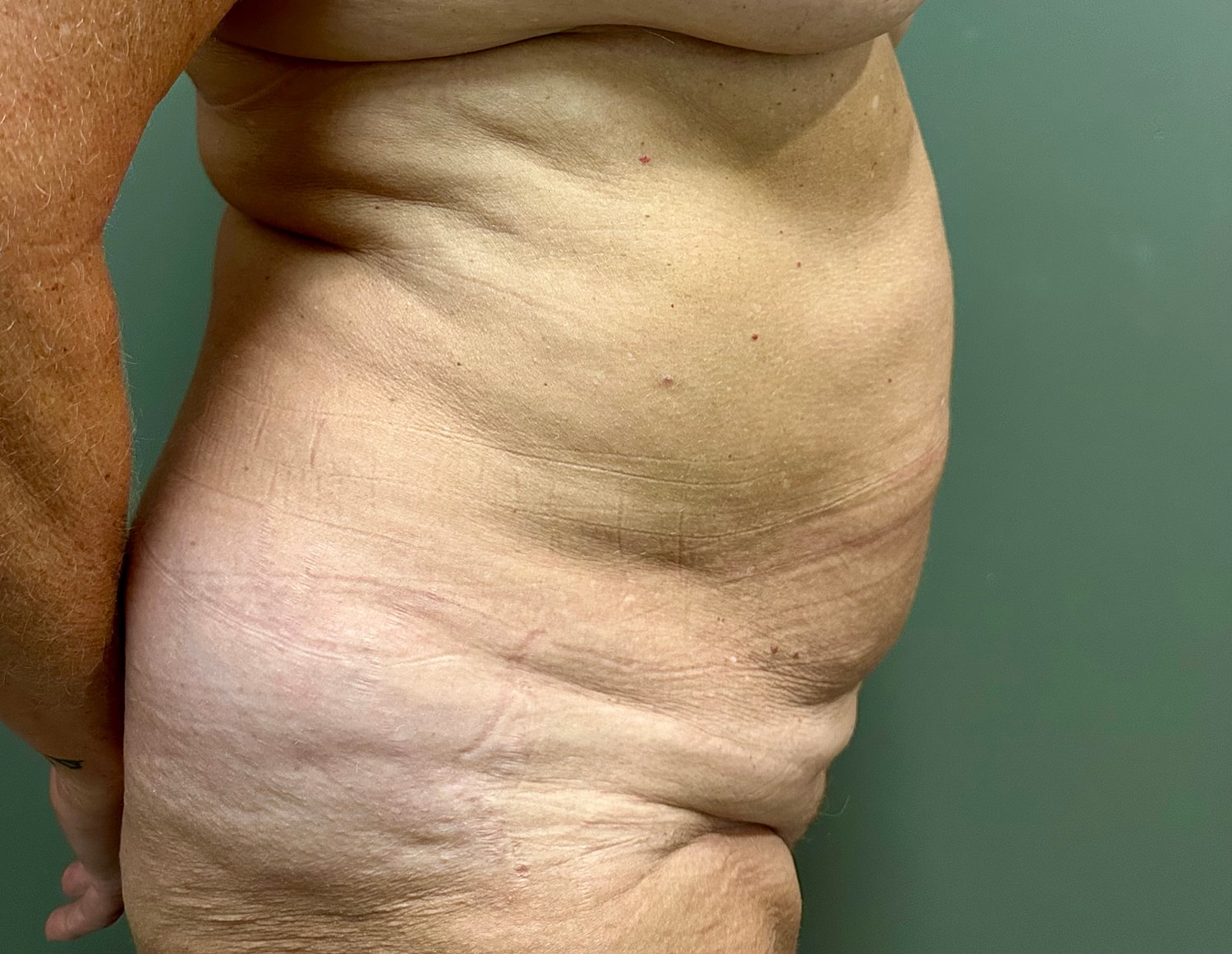 Abdominoplasty Before & After