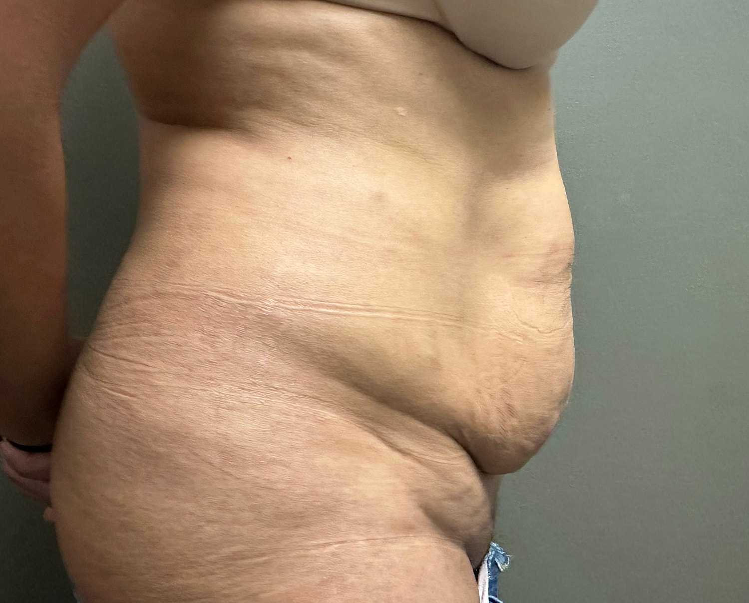 Abdominoplasty Before & After