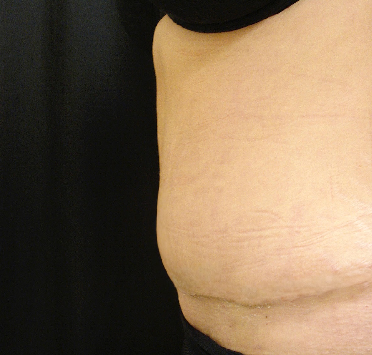 Abdominoplasty Before & After