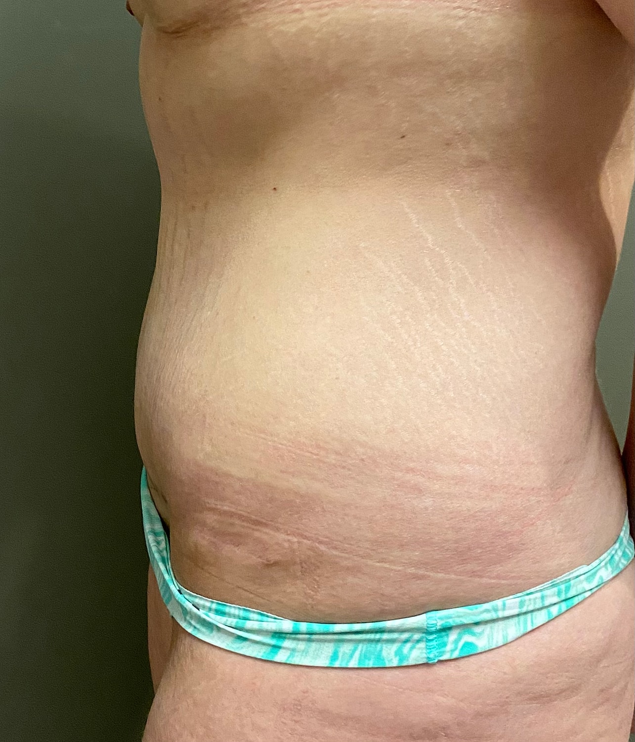 Abdominoplasty Before & After