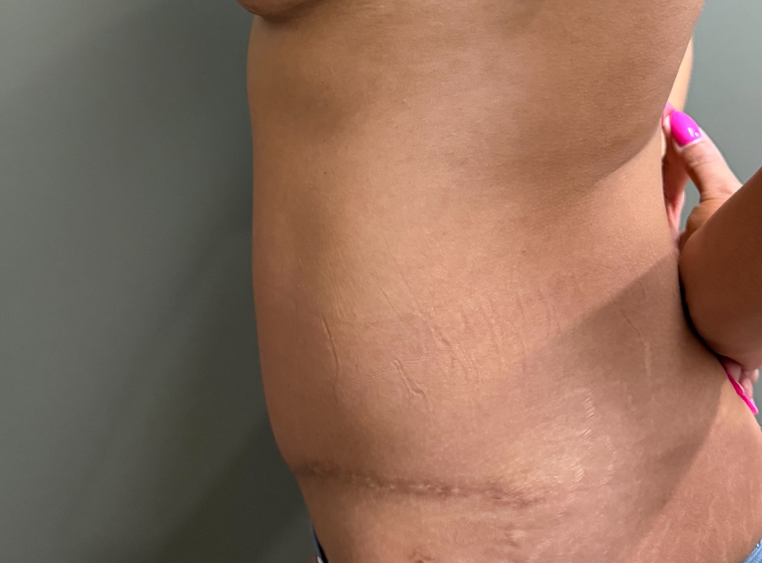 Abdominoplasty Before & After