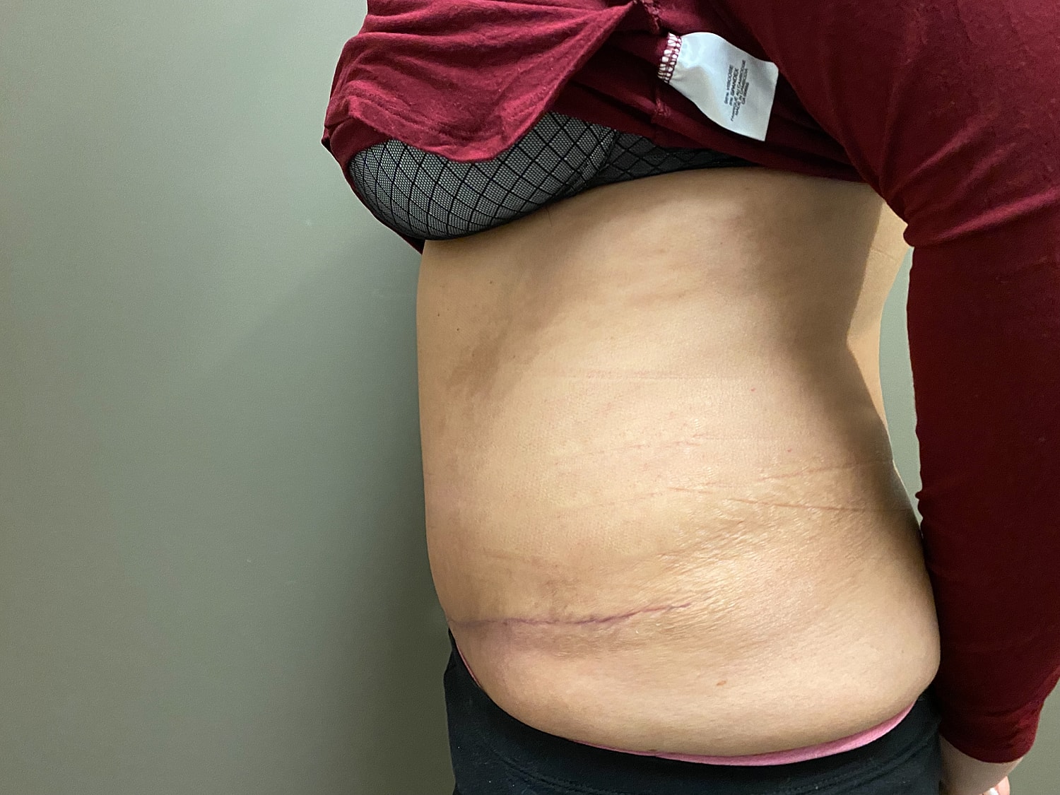 Abdominoplasty Before & After