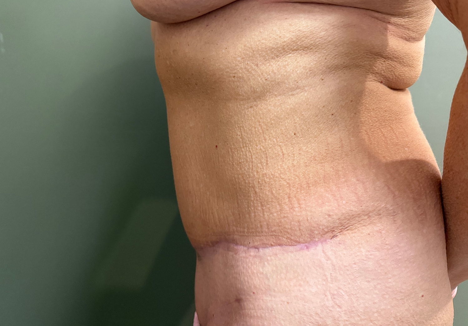 Abdominoplasty Before & After