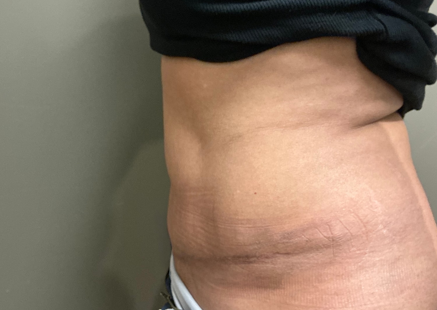 Abdominoplasty Before & After