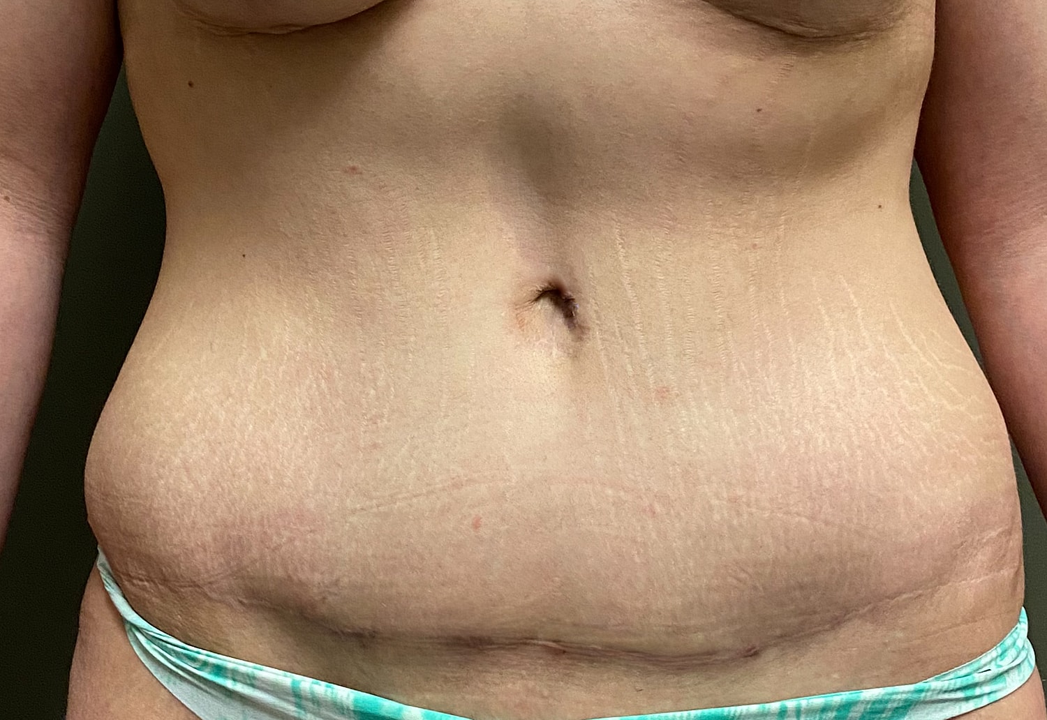 Abdominoplasty Before & After
