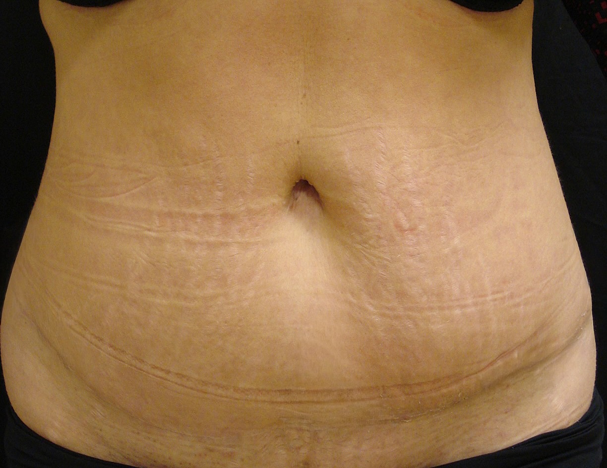 Abdominoplasty Before & After