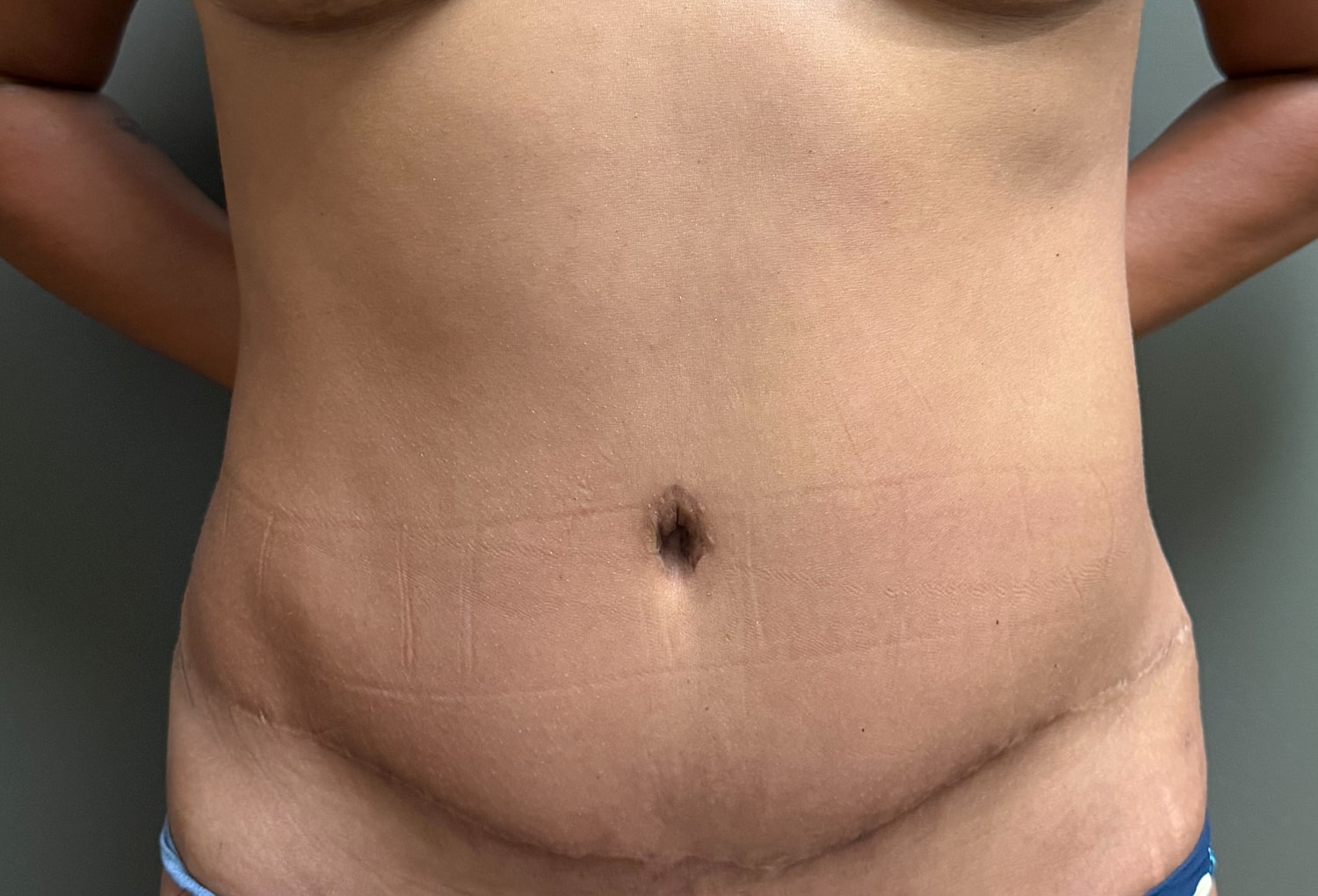 Abdominoplasty Before & After