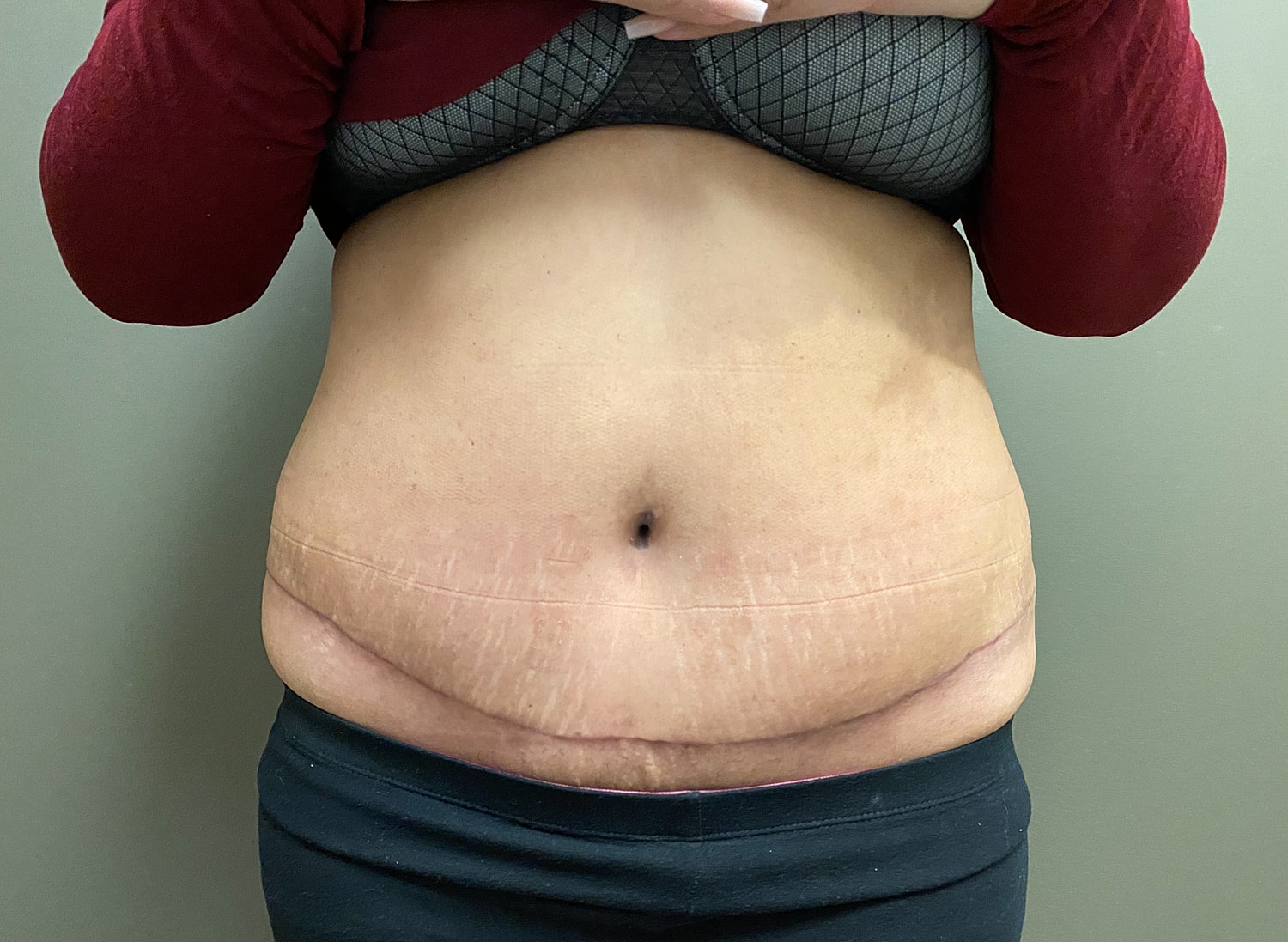 Abdominoplasty Before & After