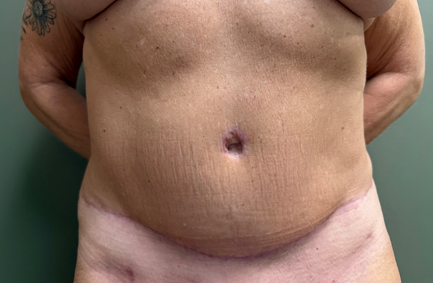Abdominoplasty Before & After