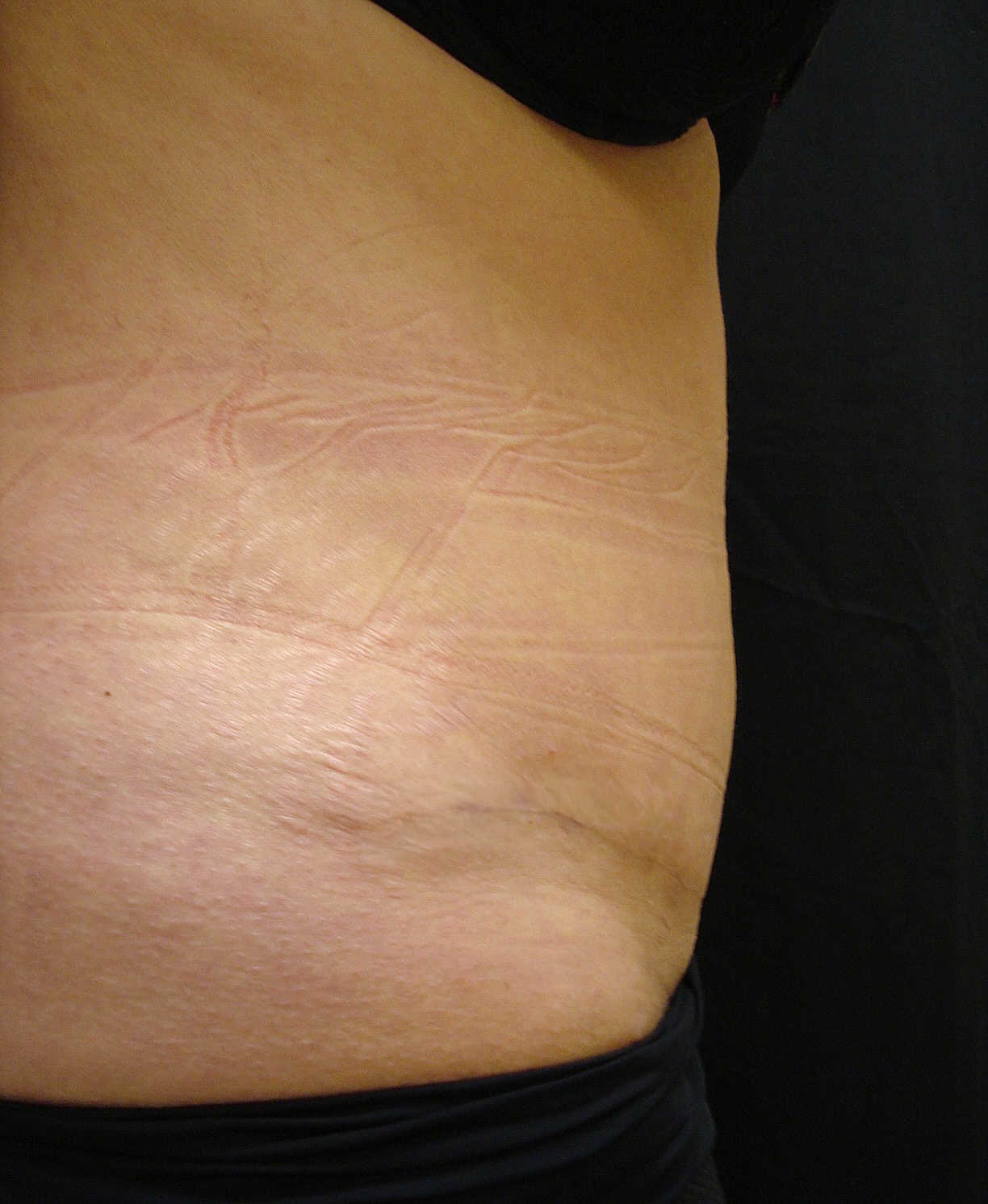 Abdominoplasty Before & After
