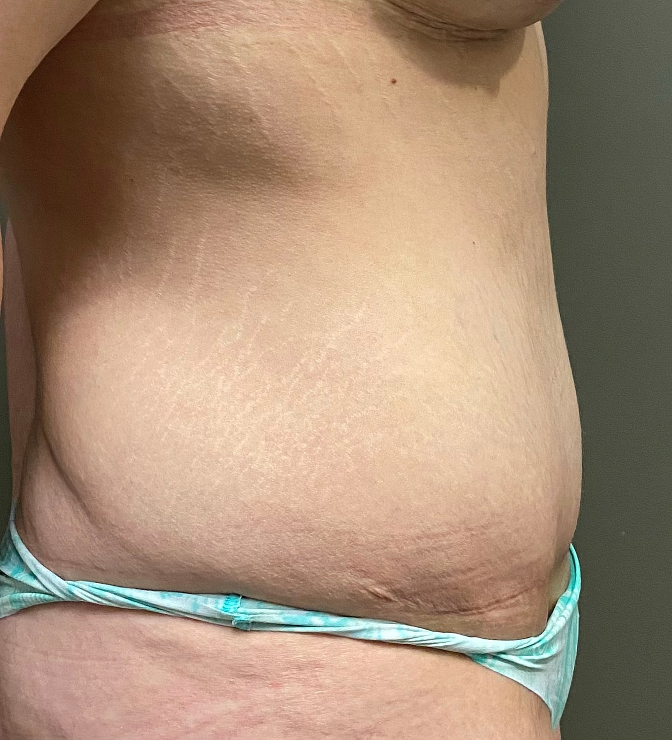 Abdominoplasty Before & After