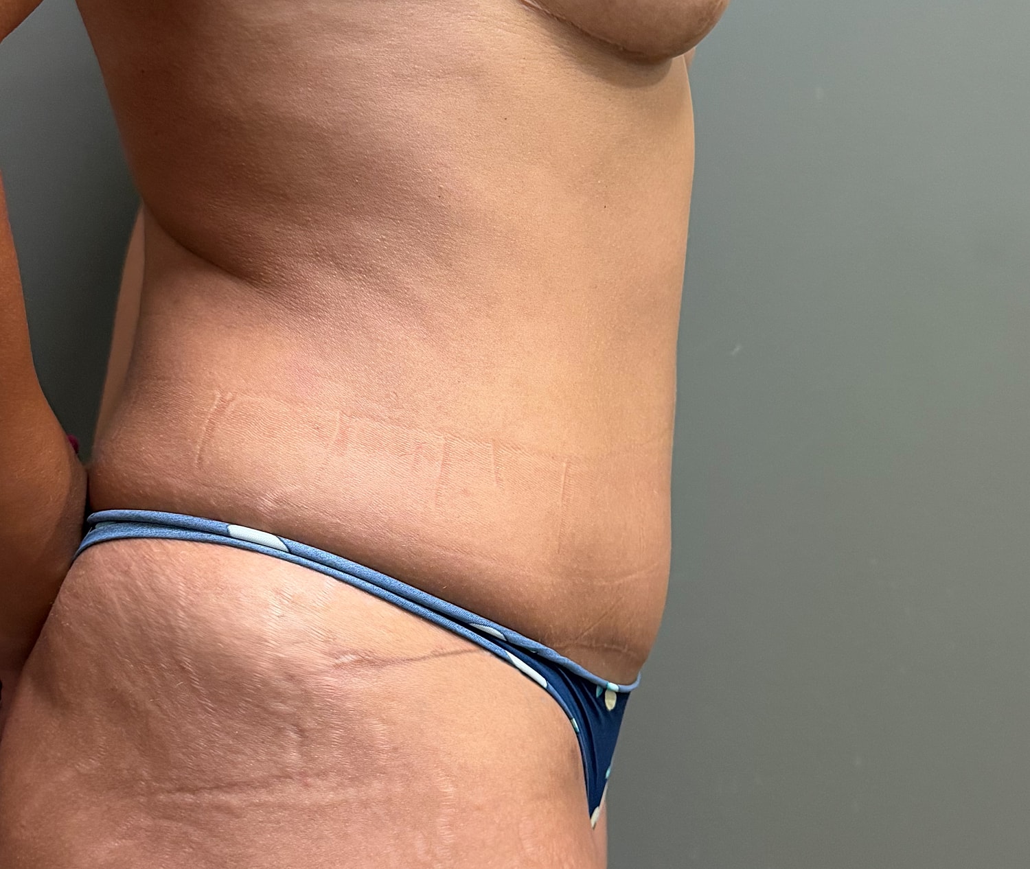 Abdominoplasty Before & After