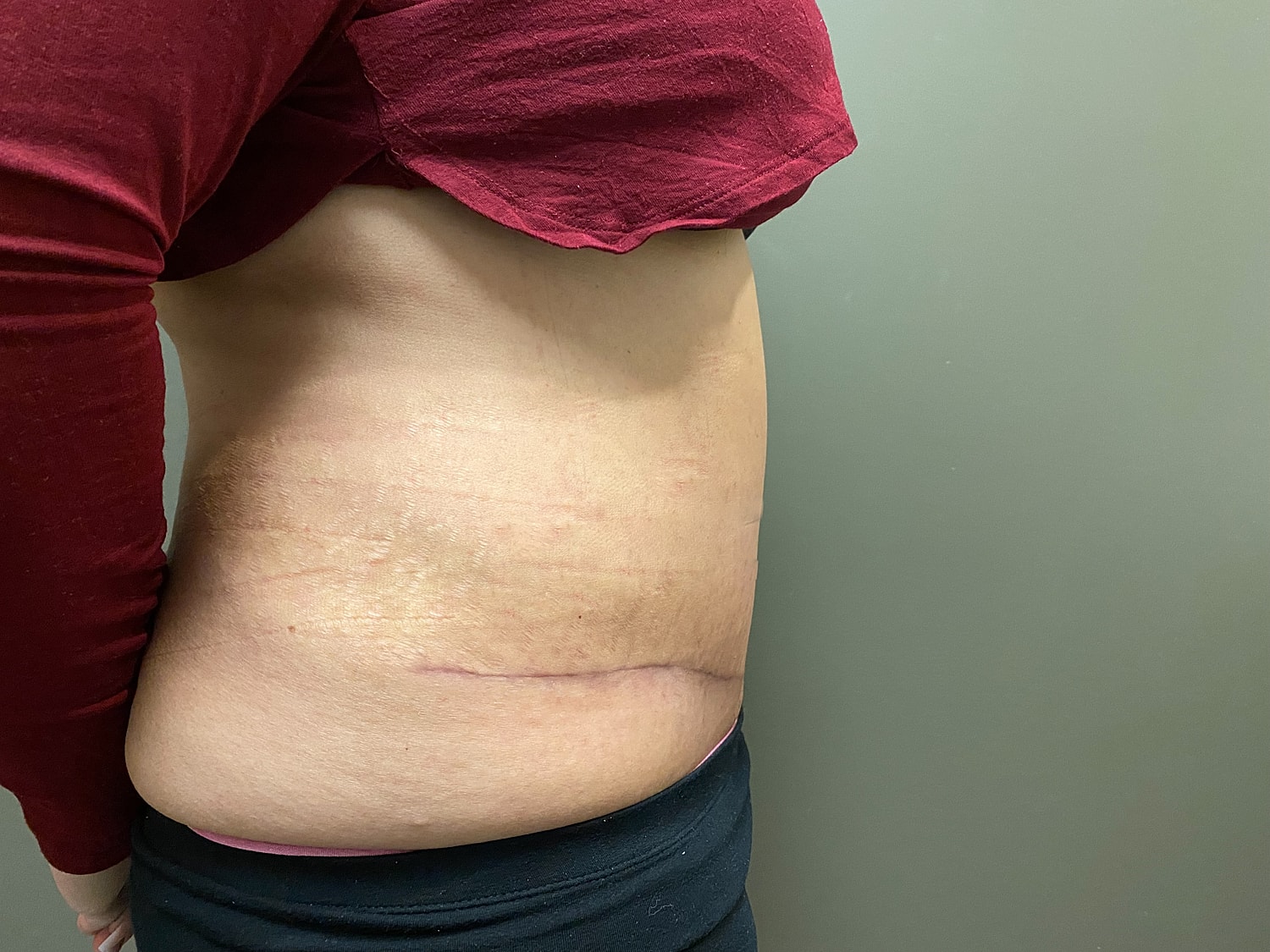 Abdominoplasty Before & After