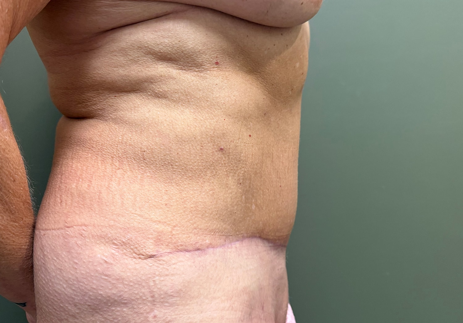 Abdominoplasty Before & After