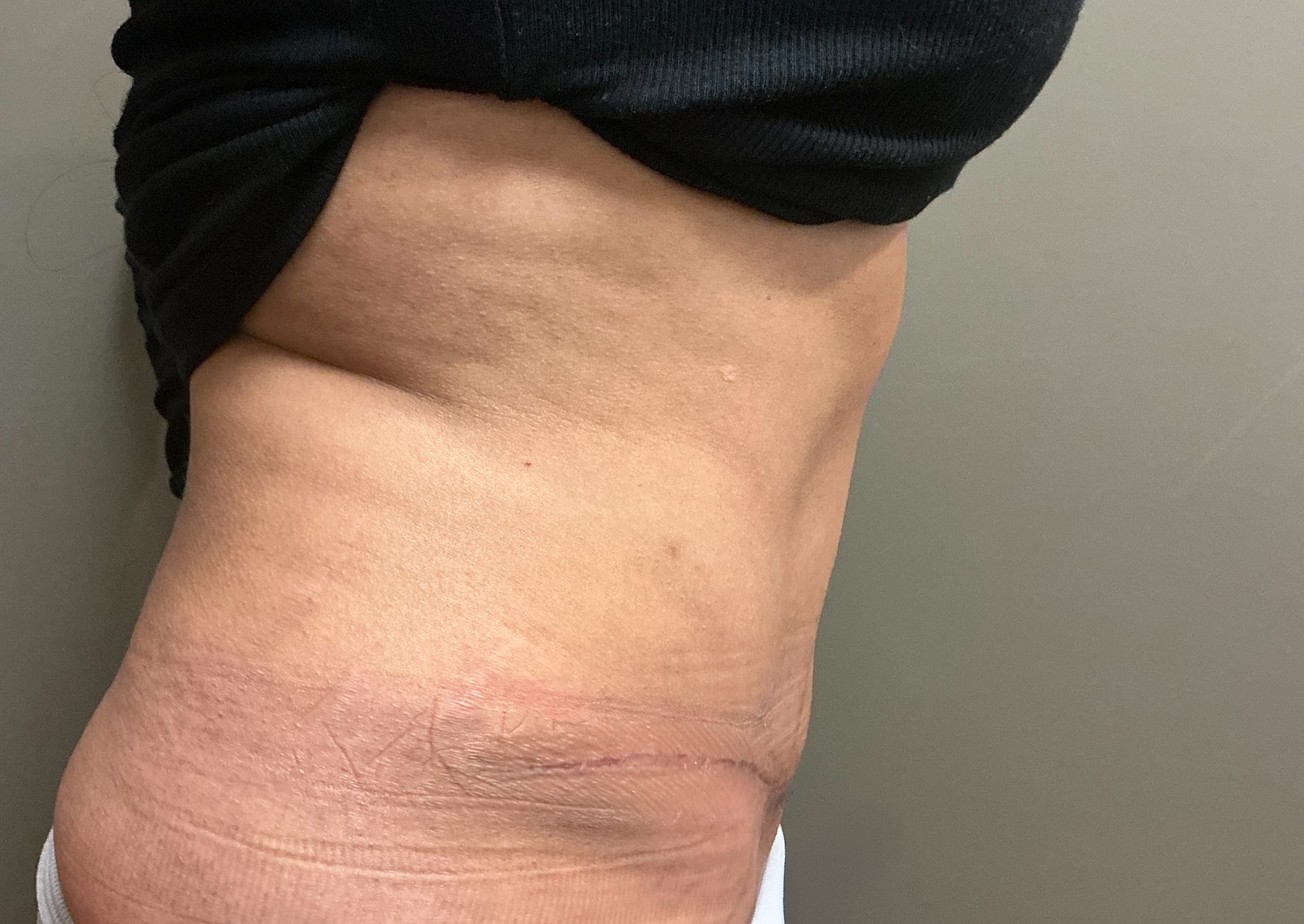 Abdominoplasty Before & After