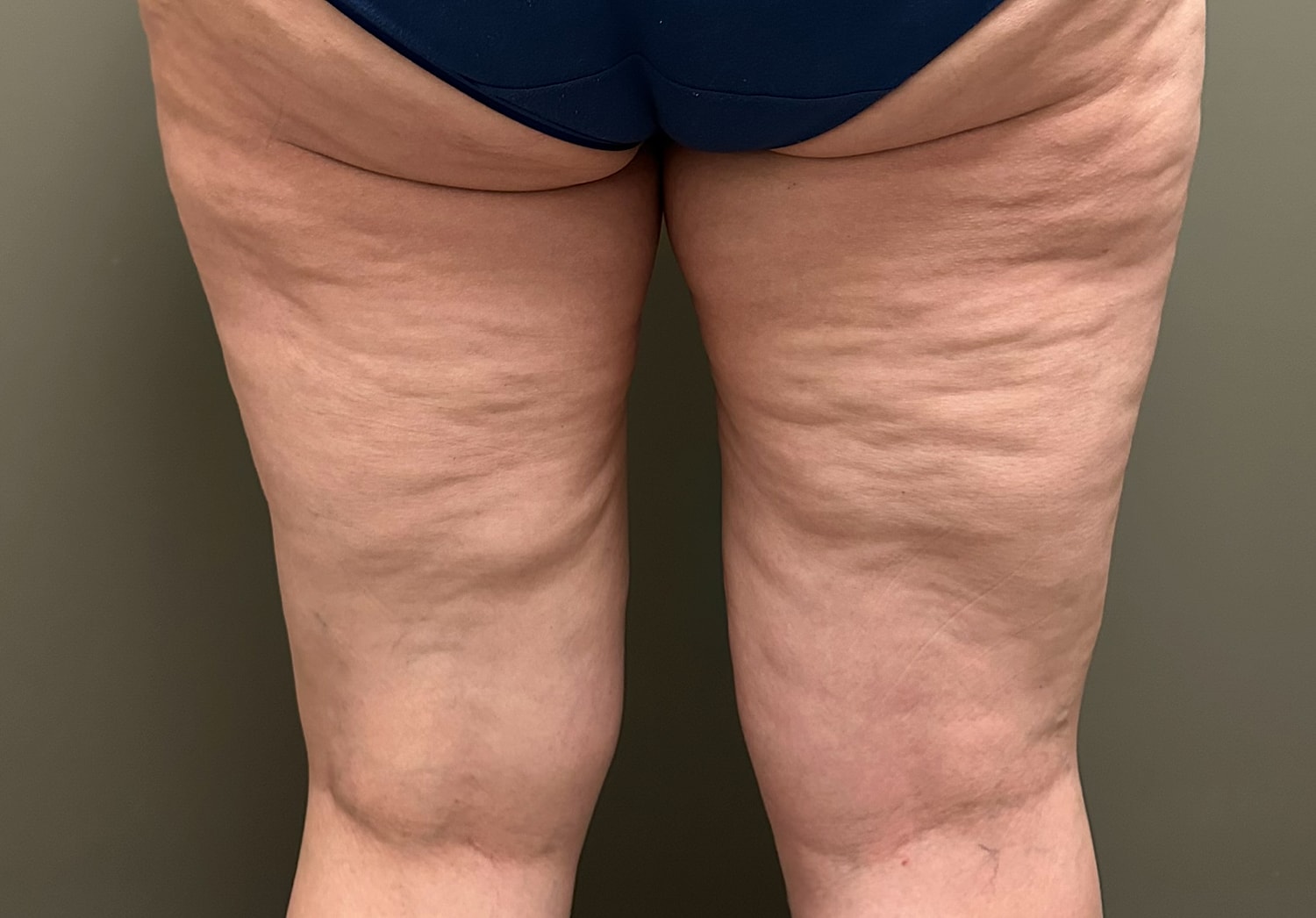 THIGH LIFT Before & After