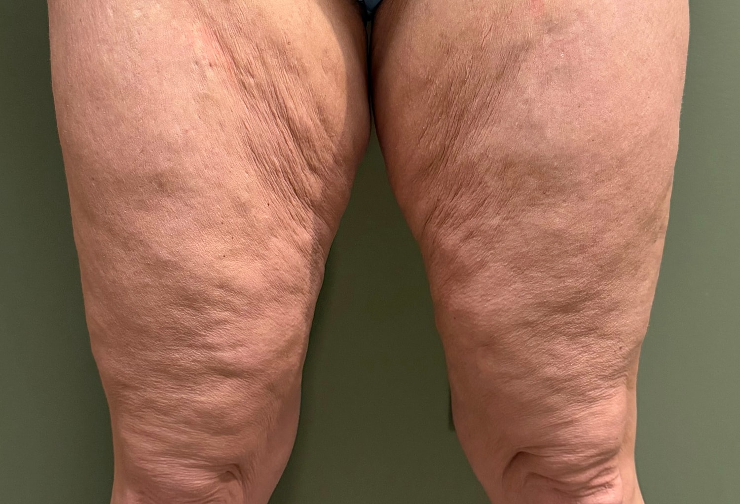 THIGH LIFT Before & After