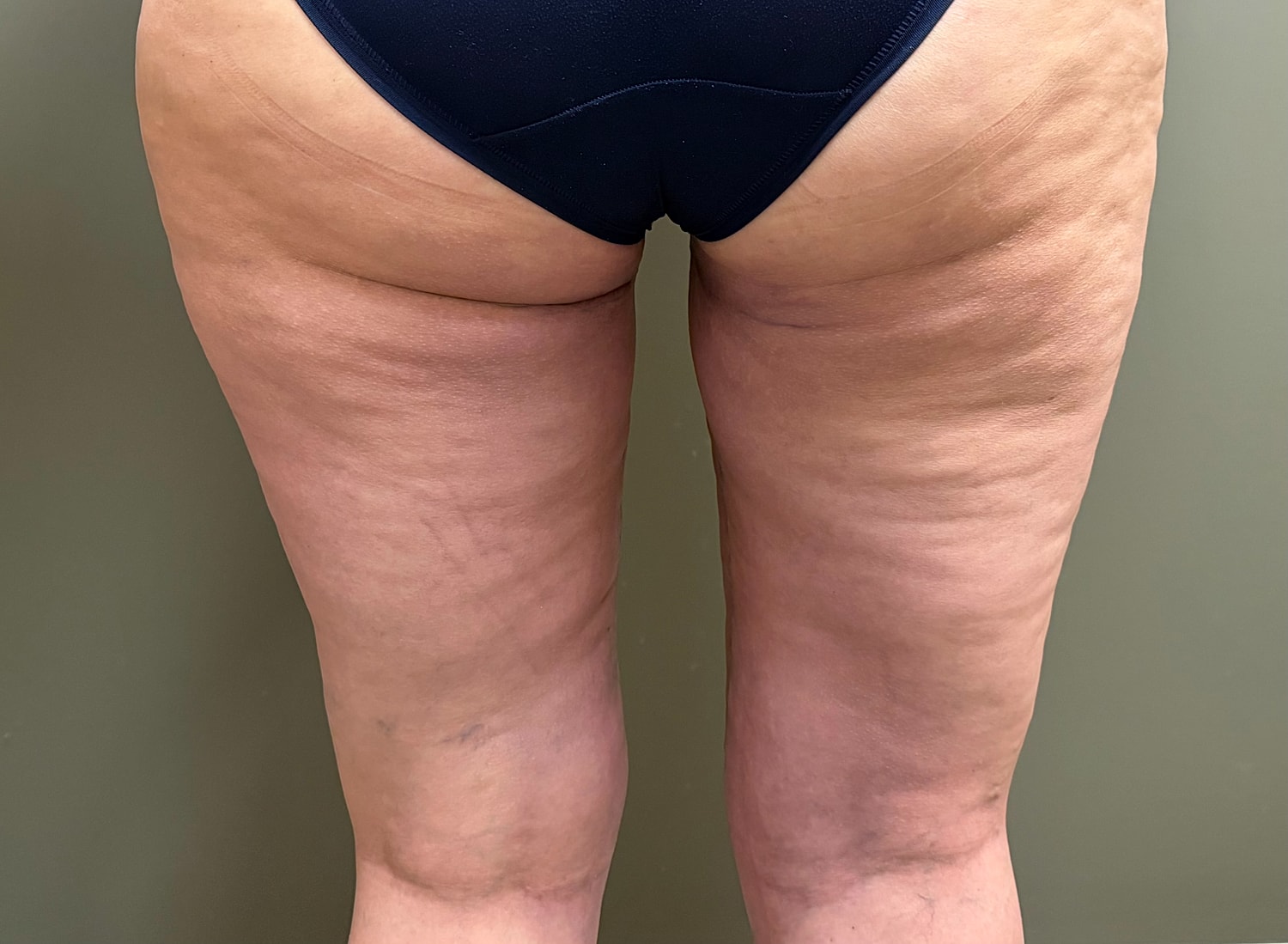 THIGH LIFT Before & After
