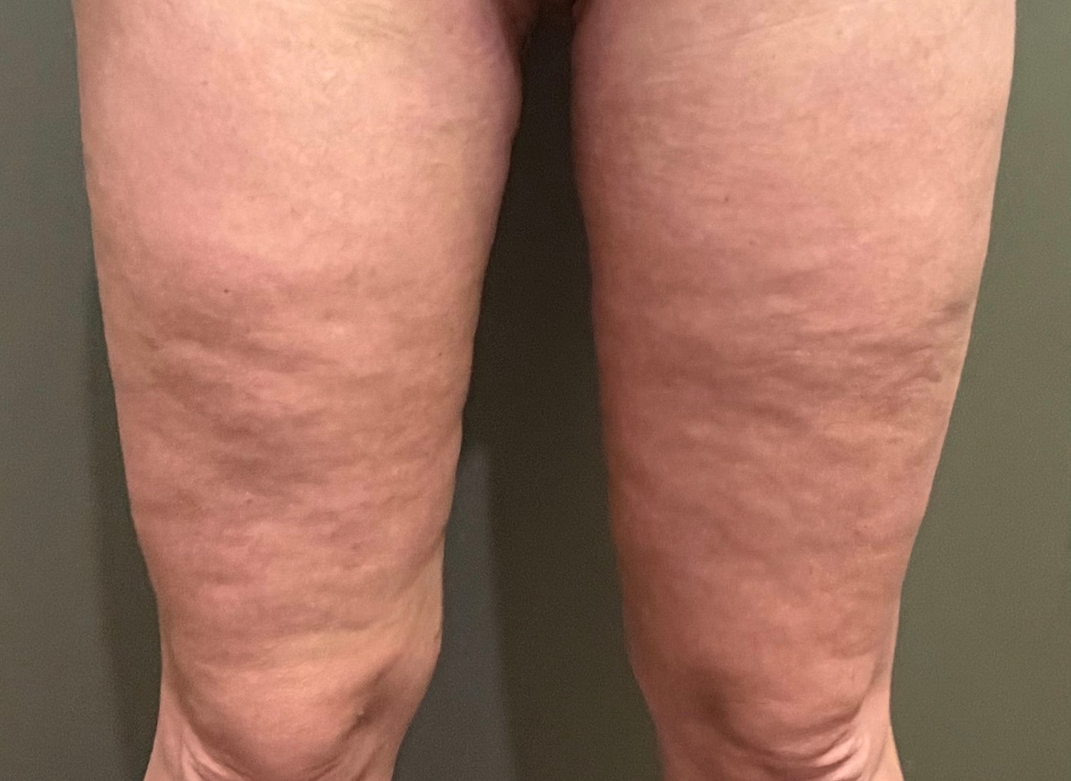 THIGH LIFT Before & After