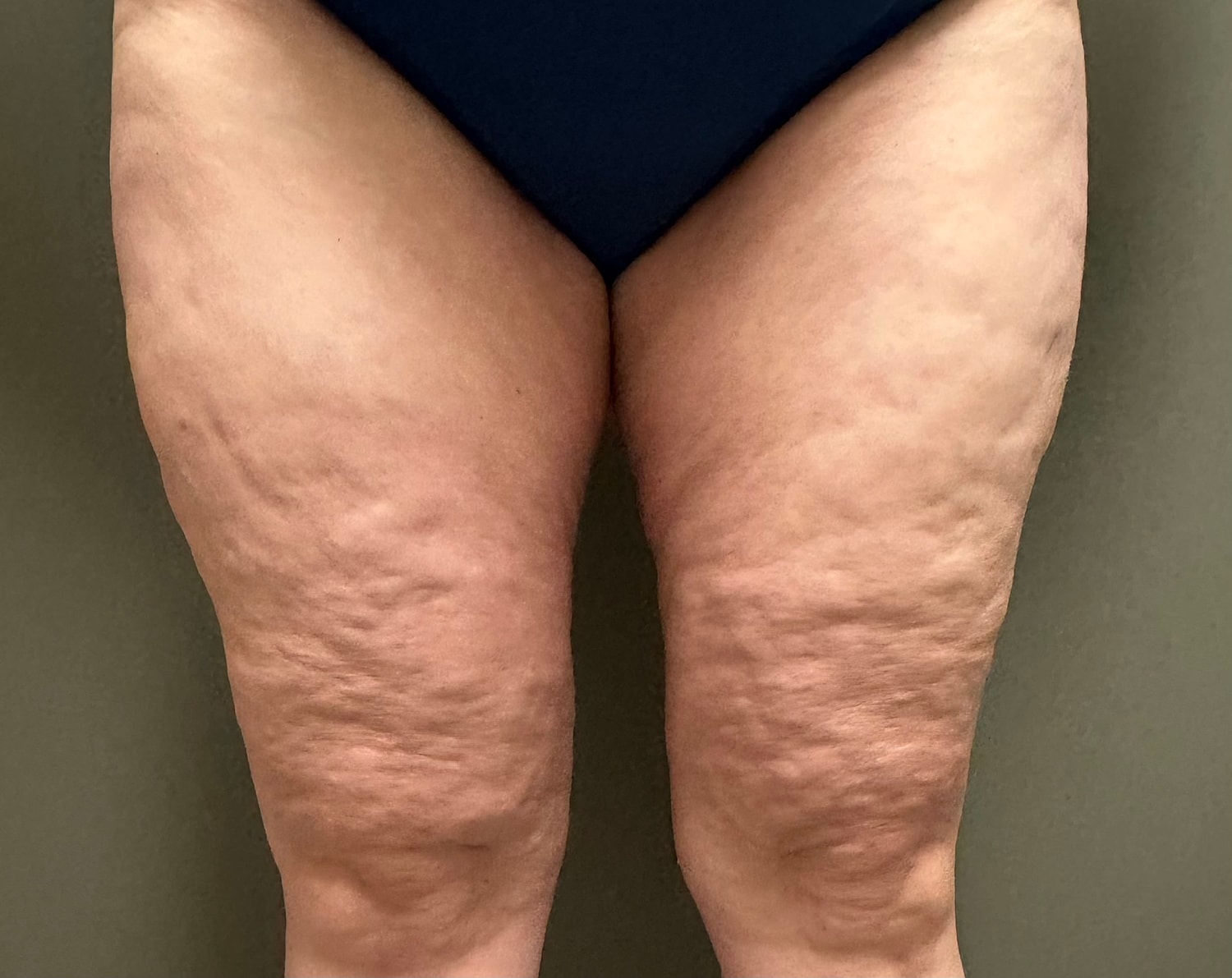 THIGH LIFT Before & After
